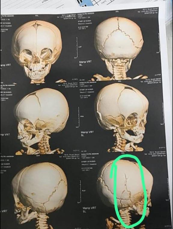 <p>Foto hasil ronsen pemeriksaan korban di RSUD dr Murjani Sampit, Kamis (23/10/2025). (Foto: Ist) </p>